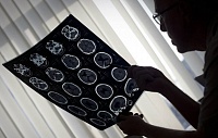 Открыта новая форма афазии, возникающая после удаления опухоли из мозга Открыта новая форма афазии, возникающая после удаления опухоли из мозга