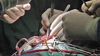 Сибирские кардиологи разработали новый сверхточный метод лечения аритмии Сибирские кардиологи разработали новый сверхточный метод лечения аритмии