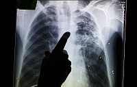 Туберкулез заподозрили во влиянии на генетическую эволюцию человечества Туберкулез заподозрили во влиянии на генетическую эволюцию человечества