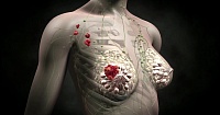 Выявлены бактерии, способствующие появлению метастаз рака груди Выявлены бактерии, способствующие появлению метастаз рака груди