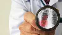 У части пациентов, переболевших COVID-19, обнаружили длительное повреждение легких У части пациентов, переболевших COVID-19, обнаружили длительное повреждение легких