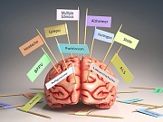 Между болезнями Паркинсона, Альцгеймера и Хантингтона есть сходство Между болезнями Паркинсона, Альцгеймера и Хантингтона есть сходство